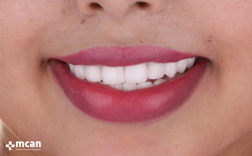 Zirconia vs. Emax Crowns: Which One Offers the Best Aesthetics? 2 What Are Zirconia Crowns - MCAN Dental