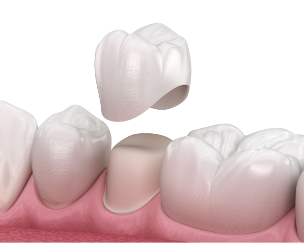 Who Is Suitable for Zirconium Crowns in Turkey - MCAN Dental