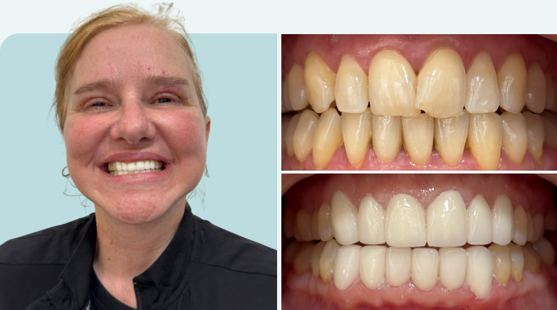 Zirconium Crown Result Before After 10 - MCAN Dental