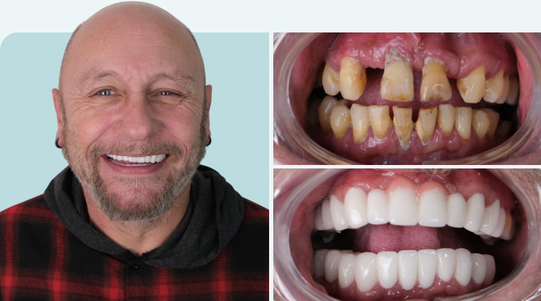 Zirconium Crown Result Before After 11 - MCAN Dental