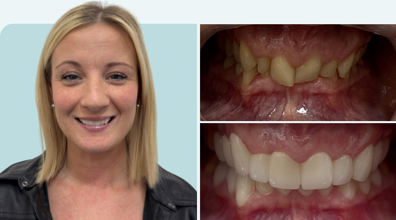 Zirconium Crown Result Before After 14 - MCAN Dental