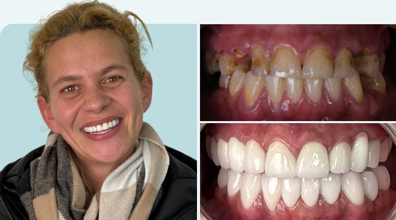 Zirconium Crown Result Before After 2 - MCAN Dental