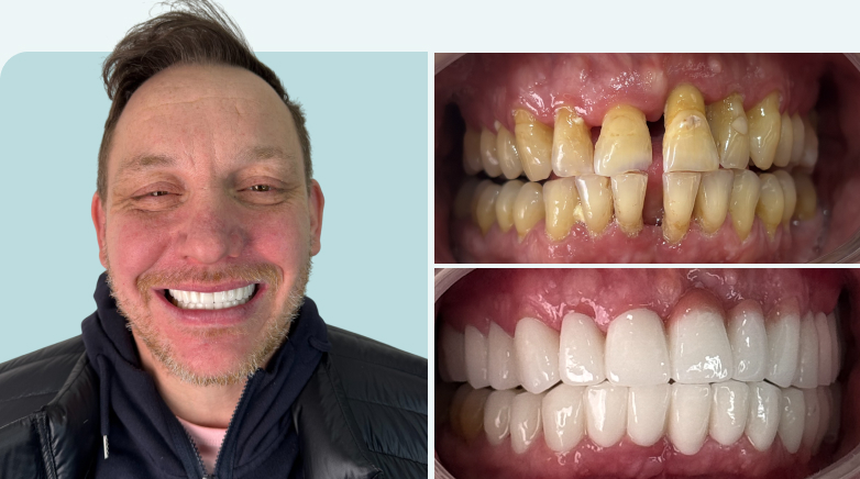 Zirconium Crown Result Before After 4 - MCAN Dental