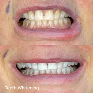 Is Teeth Whitening Safe? A Closer Look at Ingredients, Methods, and Results 4 2Tips for Safe and Effective Whitening - MCAN Dental