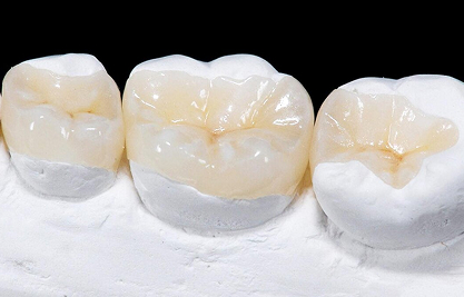 Composite Inlays Onlays - MCAN Dental