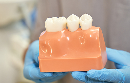 Dental Crowns - MCAN Dental