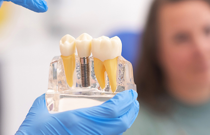 Dental Implants - MCAN Dental