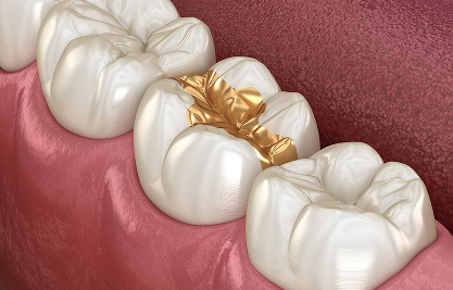 Gold Inlays Onlays - MCAN Dental