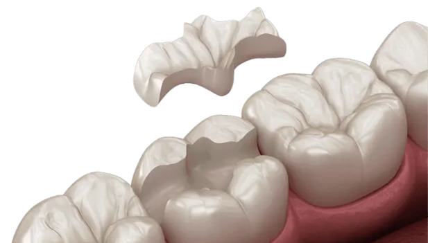 Inlay 1 - MCAN Dental