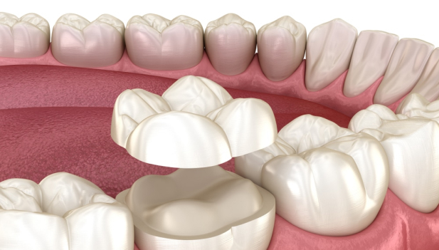 Inlay - MCAN Dental