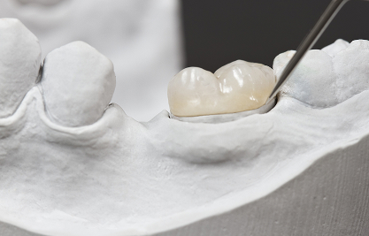 Porcelain Inlays Onlays - MCAN Dental