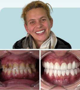 Smile Makeover in Turkey Before After 4 - MCAN Dental