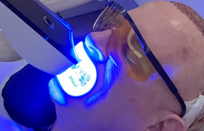 Teeth Whitening - MCAN Dental