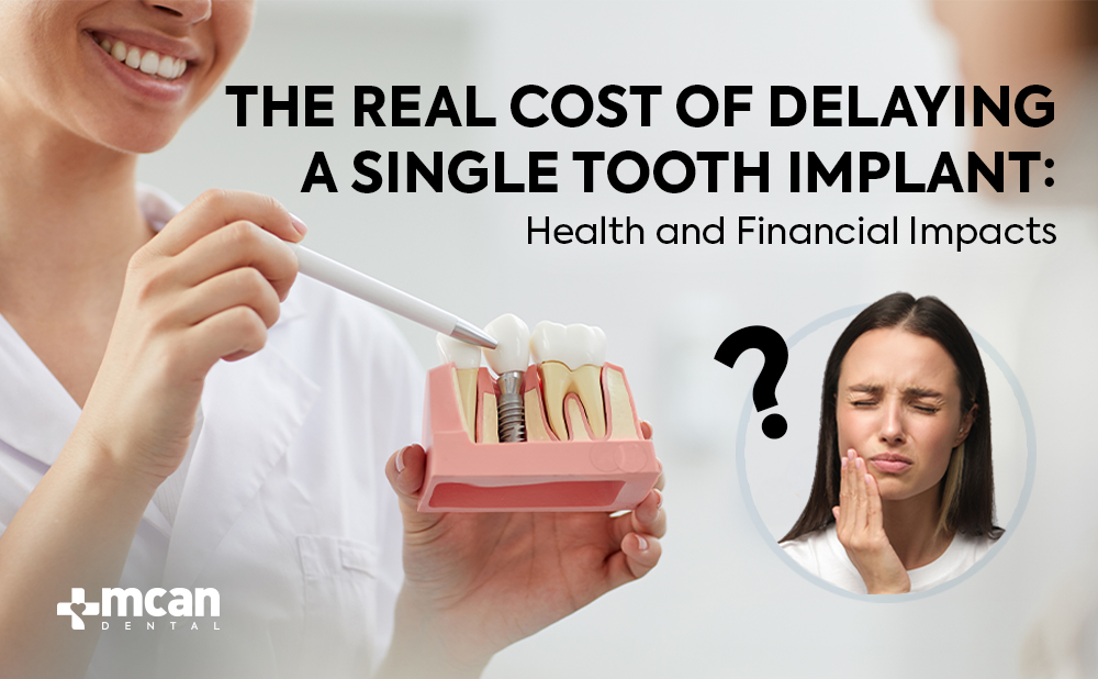 The Real Cost of Delaying a Single Tooth Implant Cover - MCAN Dental