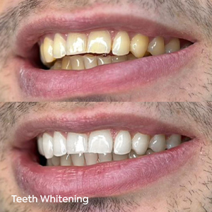 Is Teeth Whitening Safe? A Closer Look at Ingredients, Methods, and Results 3 Tips for Safe and Effective Whitening - MCAN Dental