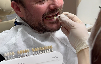 Veneers and Lumineers - MCAN Dental