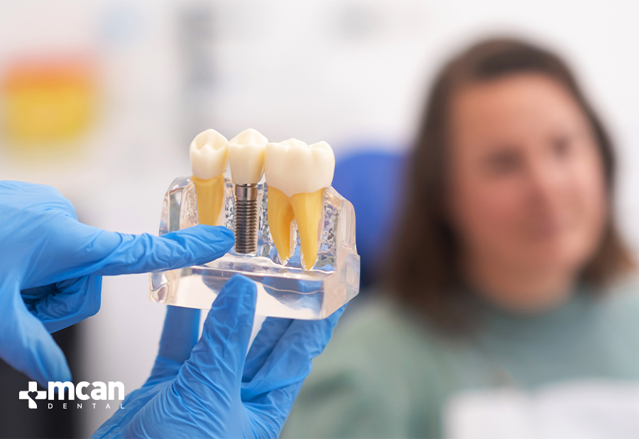 What Is a Single Tooth Implant - MCAN Dental