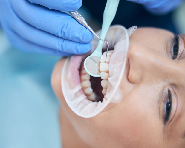 Who Is Suitable for Inlay Onlay in Turkey - MCAN Dental
