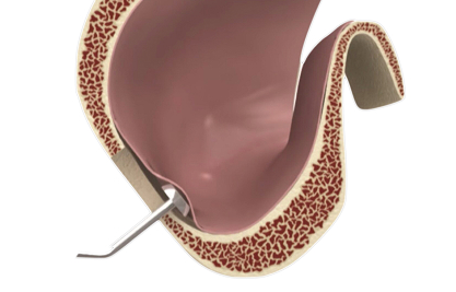 crestal sinus lift - MCAN Dental