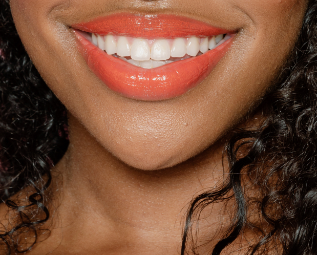 gummy smile - MCAN Dental