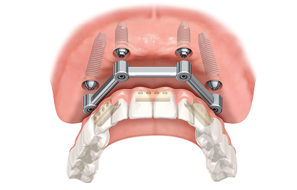 image 1 1 - MCAN Dental