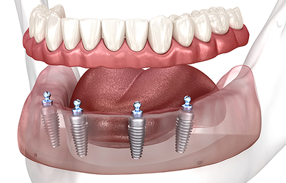 image 1 - MCAN Dental