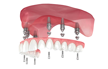 image 2 1 - MCAN Dental