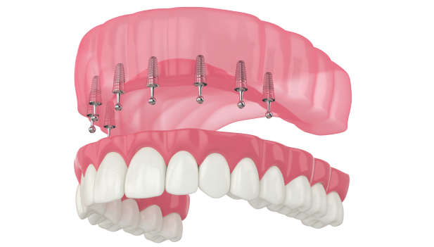 implant supported denture - MCAN Dental