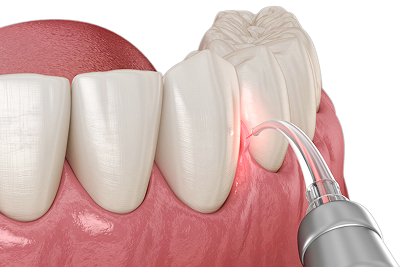 laser gum - MCAN Dental
