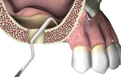lateral sinusl lift - MCAN Dental