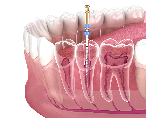 who is suitable root canal - MCAN Dental
