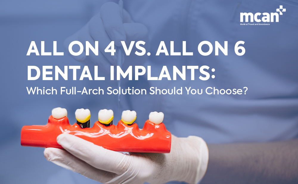 All on 4 vs. All on 6 Dental Implants: Which Full-Arch Solution Should You Choose? 1 All on 4 vs. All on 6 Dental Implants cover - MCAN Dental