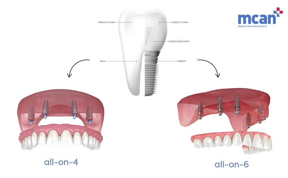 All on 4 vs. All on 6 Dental Implants: Which Full-Arch Solution Should You Choose? 2 What Are All on 4 and All on 6 Dental Implants - MCAN Dental
