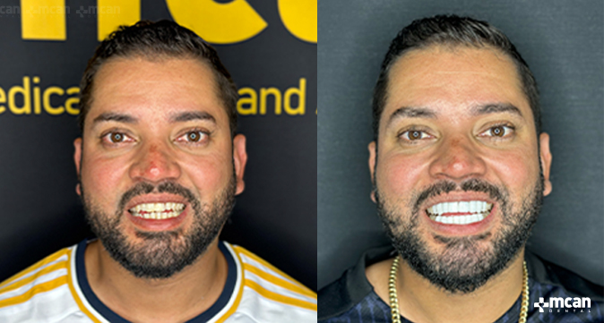Smile Design vs. Hollywood Smile: What’s the Difference? 4 What Dental Issues Can Smile Design and Hollywood Smile Address - MCAN Dental