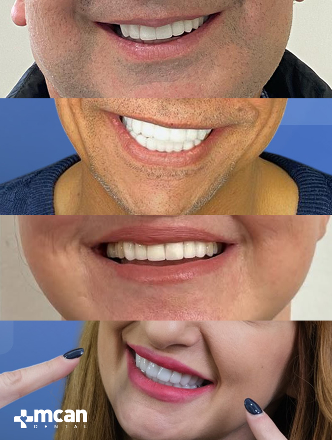 Smile Design vs. Hollywood Smile: What’s the Difference? 2 What Is Smile Design - MCAN Dental