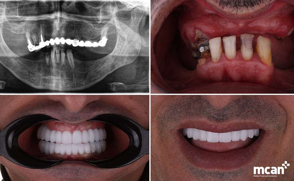 All on 4 vs. All on 6 Dental Implants: Which Full-Arch Solution Should You Choose? 3 Who Is a Better Candidate for Each Treatment - MCAN Dental